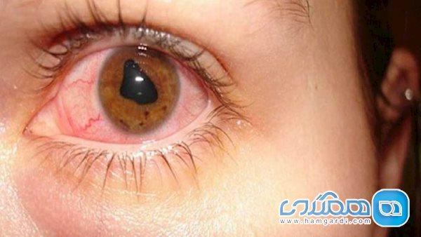 مالیدن چشم ها باعث این بیماری می شود مالیدن چشم ها باعث این بیماری می شود