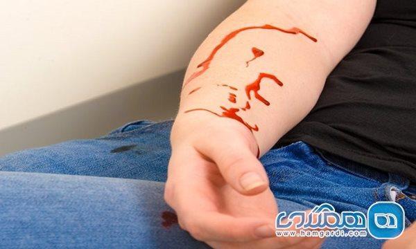 دانستنی هایی درباره خونریزی سیاهرگی دانستنی هایی درباره خونریزی سیاهرگی